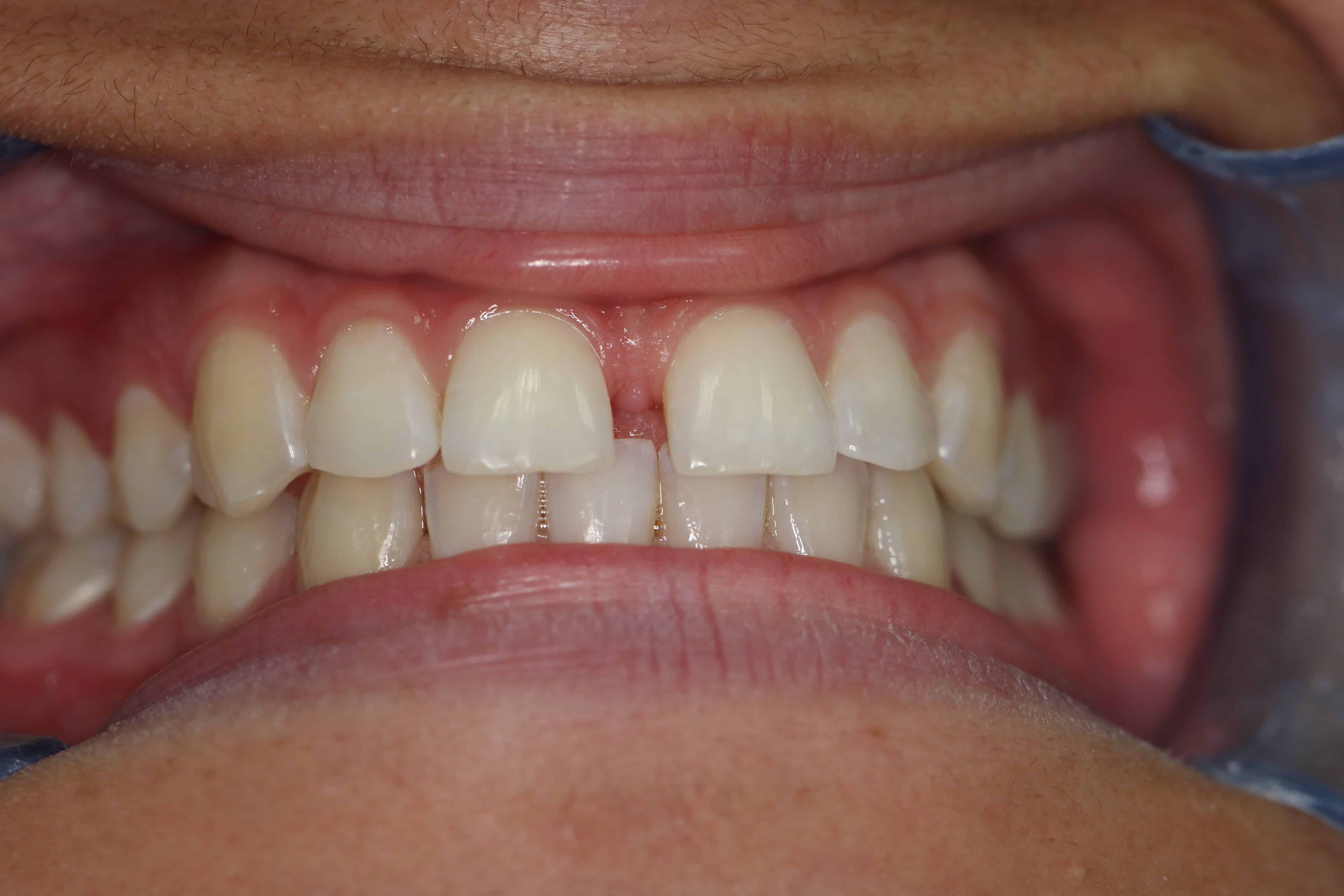 Diastema Gap Tooth Brisbane Orthodontics Before and After Southside
